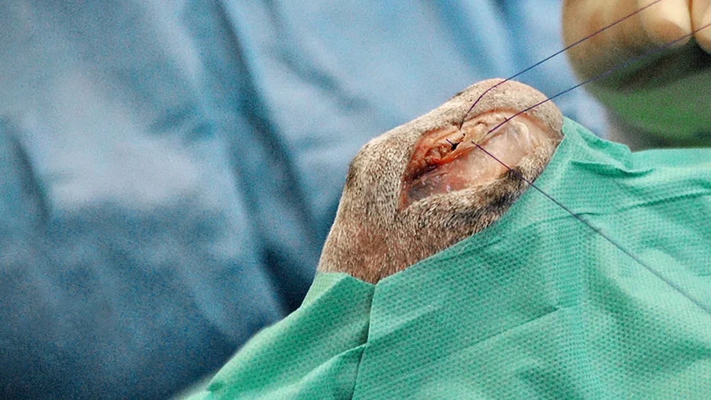 Close‑up of a dental surgical procedure, showing instruments and sutures being applied around an exposed tooth on a blue sterile drape.