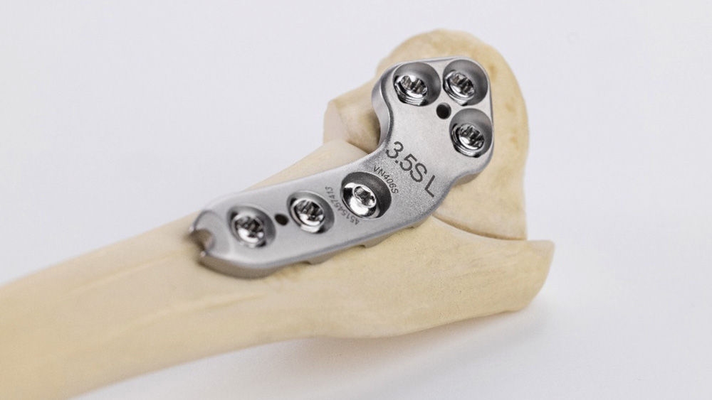 TPLO implant attached to a bone for cruciate ligament rupture restoration