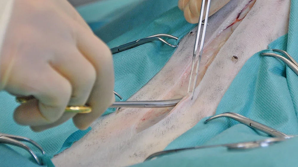 Close-up of a surgical procedure showing forceps holding a suture needle while stitching an incision in tissue, with surgical drapes visible around the operating area.