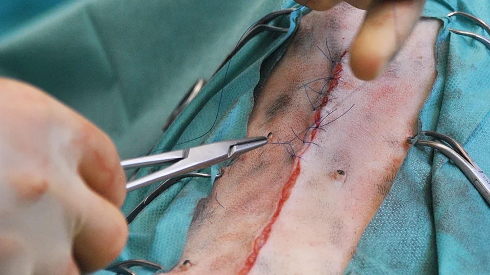 Close-up of a surgical procedure showing forceps holding a suture needle while stitching an incision in tissue, with surgical drapes visible around the operating area.