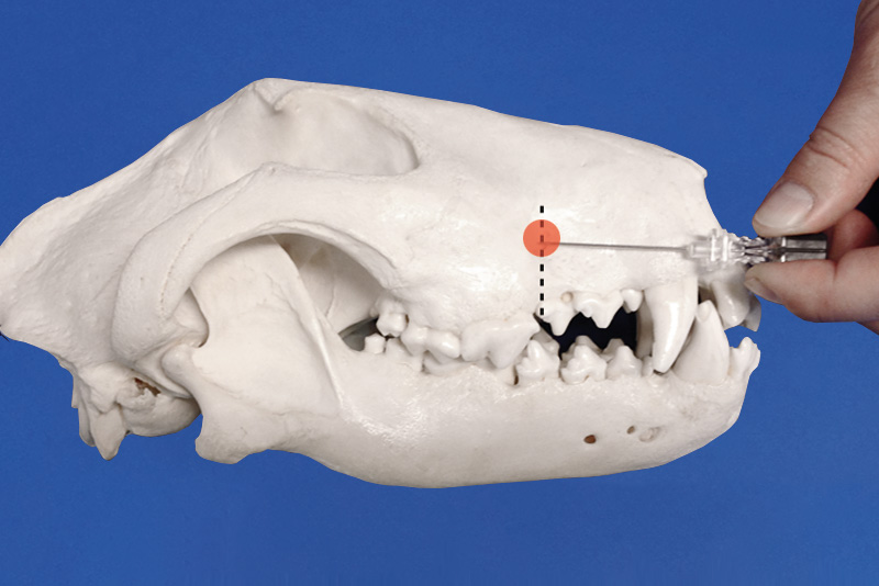 Infraorbital Nerve Block