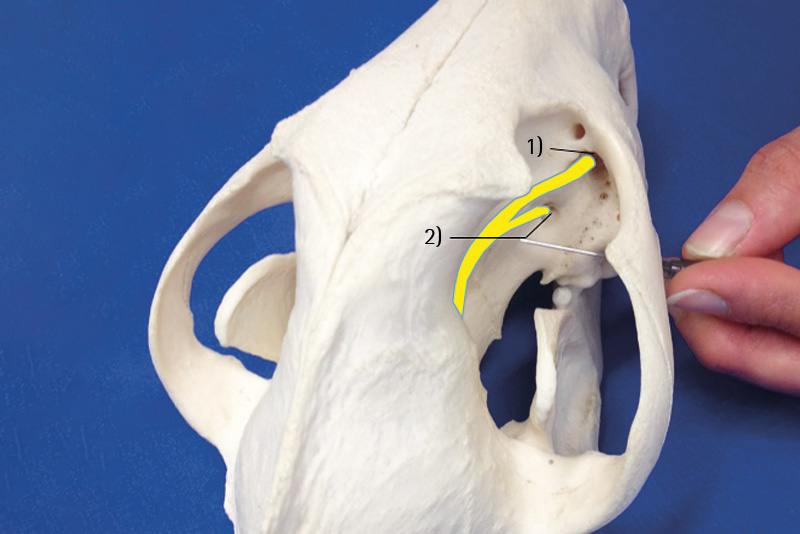 Maxillary Nerve Block